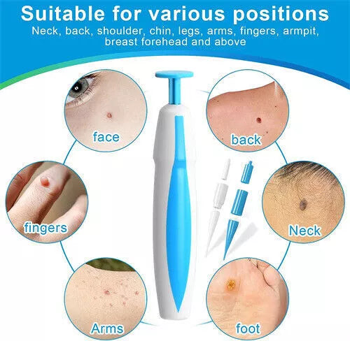 Auto Skin Tag Mole Wart Removal Kit