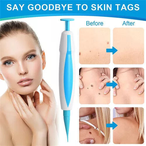 Auto Skin Tag Mole Wart Removal Kit